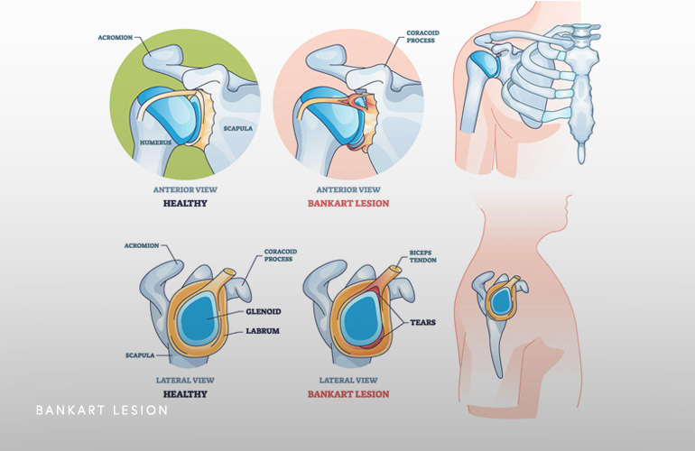 Torn Labrum After Dislocation Schaumburg Thomas Obermeyer MD Torn Labrum After Dislocation Schaumburg Thomas Obermeyer MD
