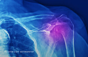 Rotator Cuff Arthropathy Schaumburg - Thomas Obermeyer, MD