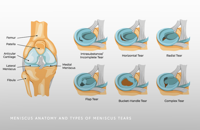 Medial Meniscus Tear Horizontal Right Leg Type 1 Medial Meniscus Tear Horizontal Right Leg Type 1